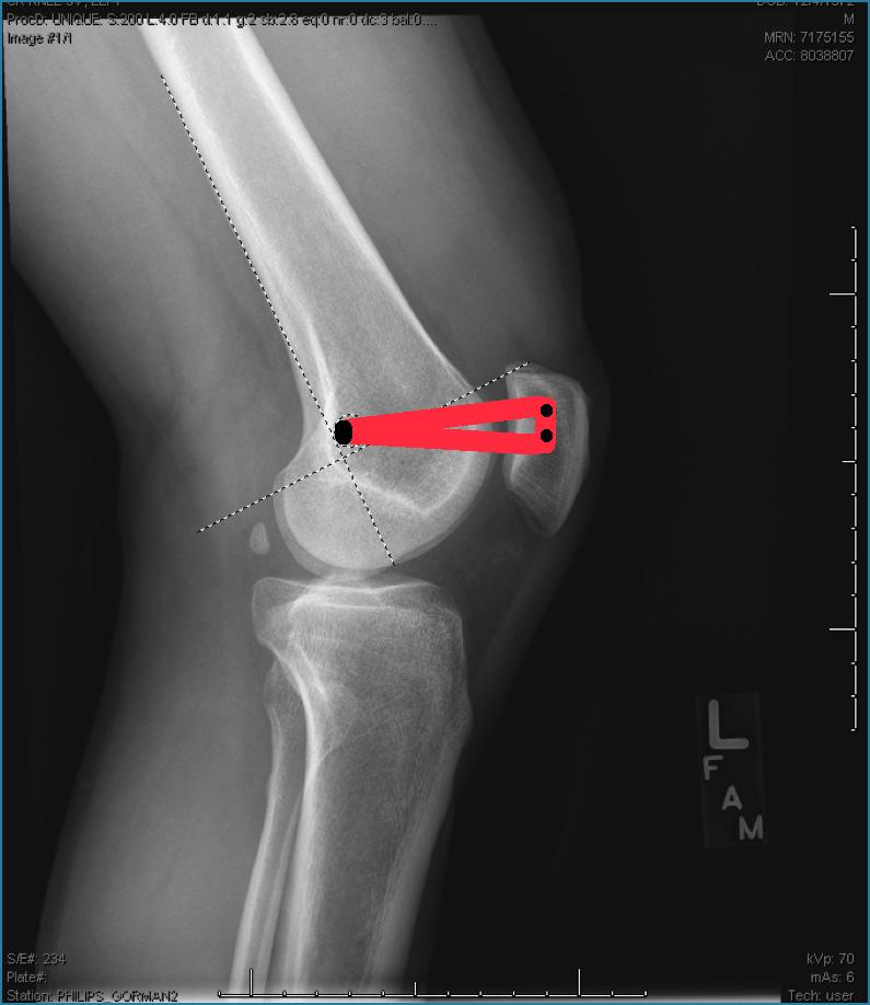 Page 11 of 13 patellar subluxation or dislocation, exam, radiographs and MRI are included in the evaluation.