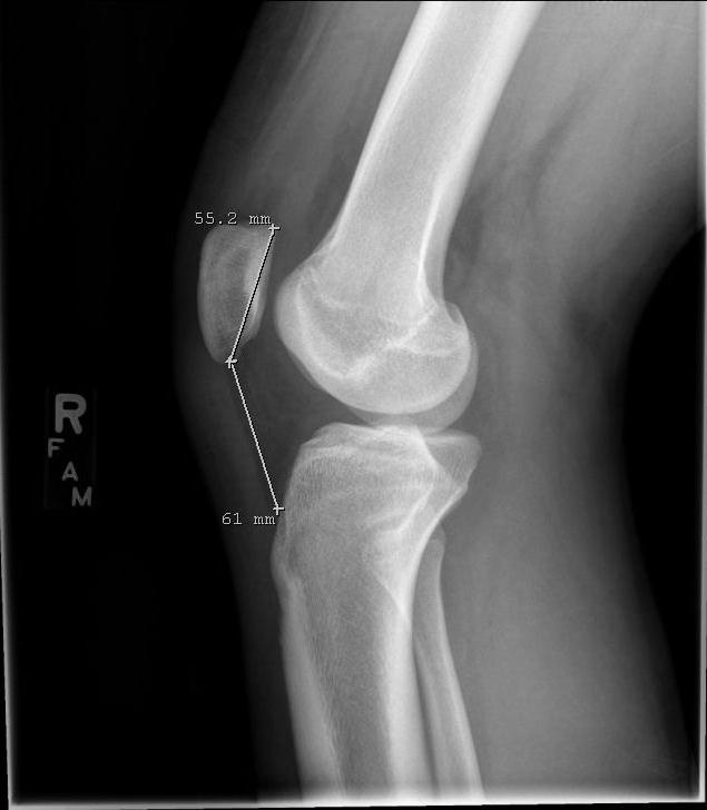Page 5 of 13 Figure 2: (a) Insall Salvati ratio: patellar tendon length (61 mm) divided by patella length (55.2 mm) is 1.10.