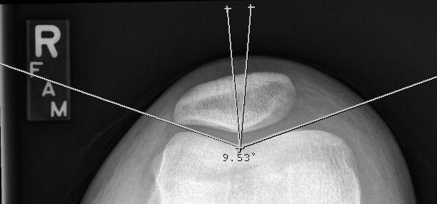 Caton Deschamps Index: distance from inferior pole of patella to anterior articular surface of tibia (61 mm) divided by length of patellar articular surface (55.2 mm) is 1.10.