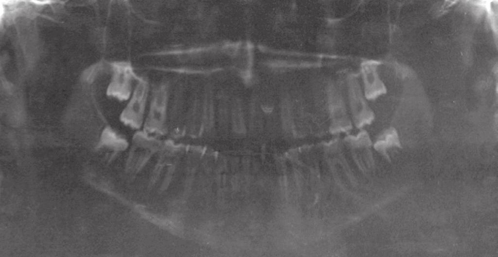 Moreover, the position of maxillary incisors was satisfactory (1-NA = 23 o and 5 mm), and his mandibular incisors were inclined lingually (1-NB = 16 o and 4 mm).