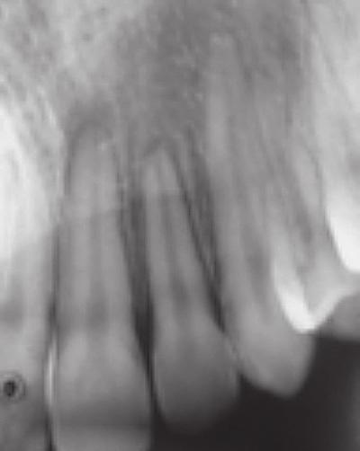 mandibular incisors.