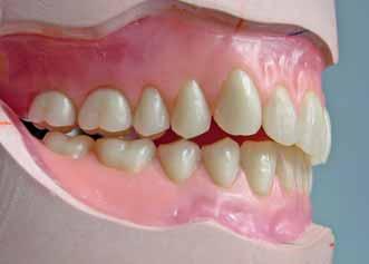 buccal on lower bicuspids Adjustments on