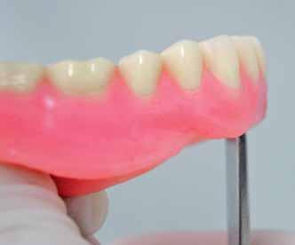 muccolabial fold Upper anteriors are set-up too far lingual