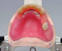 first molar a reverse cusp