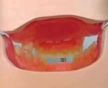 (the upper buccal cusps have