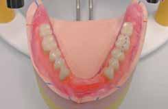 Move upper second bicuspid slightly more lingual Occlusal adjustments: lower