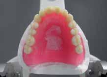 natural dentition Existing denture was