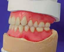Angle`s Classification of Malocclusion Dr. Edward Angle described three (3) classes of malocclusion based on the occlusal relationship of the first molars.