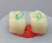 mould N mould Lower buccal