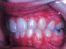 18 Anterior cross-bite In addition to treating cross-bites with mandibular displacements, correction of an anterior cross-bite may prevent labial displacement of a lower incisor, which could