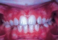 Space maintainers These are used to maintain space when teeth have been lost prematurely. The commonest reason for premature loss of teeth is caries as a result of poor diet and poor oral care.