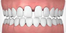 Widely spaced teeth The opposite of overcrowded teeth, widely spaced teeth occur when you have extra