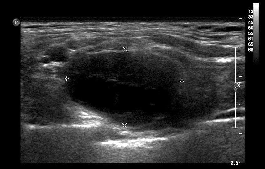 Dong Hwan Yun, et al. clavicle. Ultrasonography revealed a 1.9 1.3 2.1-cm, well-marginated heterogeneous echoic mass at the lateral side of the right sternocleidomastoid muscle (Fig. 1).