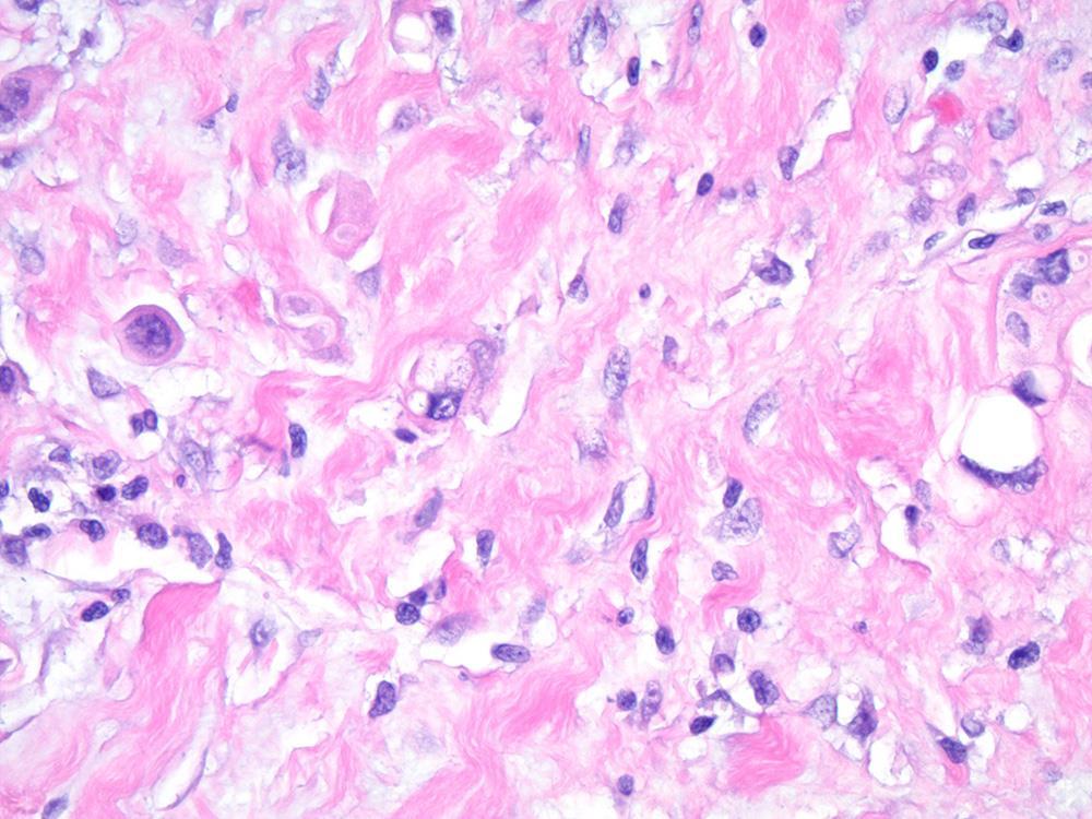 Plasmacytoid Carcinoma in Peri-Ureteral Tissue