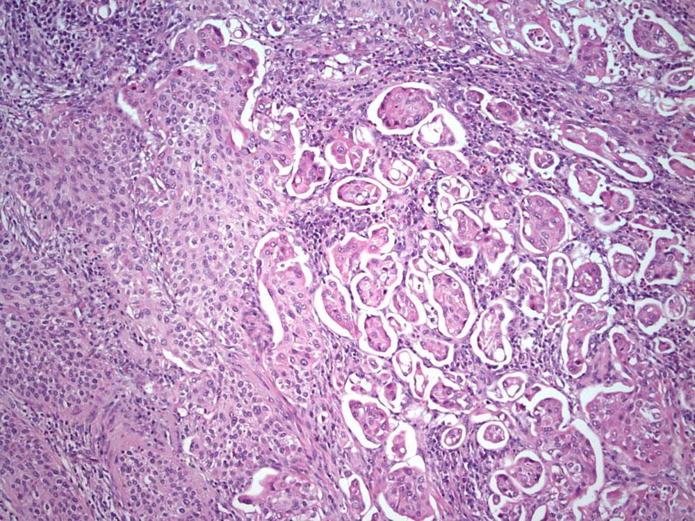 Urothelial CA with Distinct Mixed