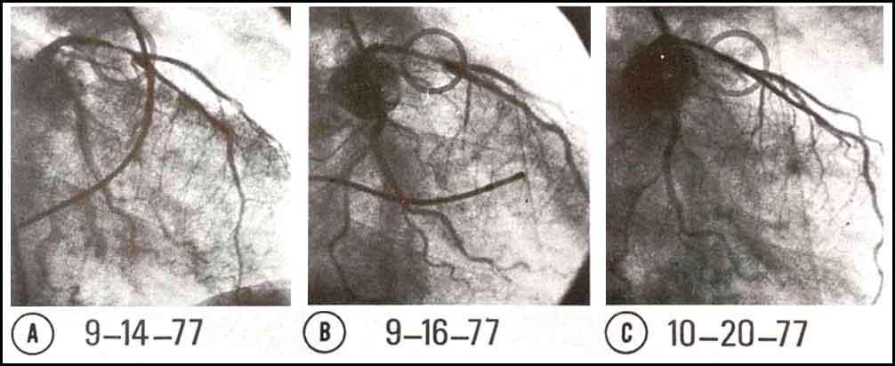 First coronary angioplasty lesion (circles) two days before (A), immediately after (B),