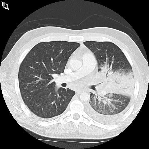 29M diagnosed with AIDS (CD4 26) two months ago - asymptomatic. He was started on prophylaxis and cart. Now presents with fever, cough, pleurisy. CD4 146. CT chest - consolidation and hilar LAN.