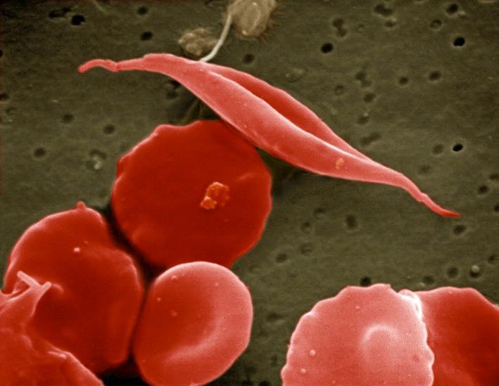 A change of a single nucleotide in the HBB gene, β-globin (on chromosome 11), causes sickle cell trait, and having this change on both copies of chromosome 11 causes sickle cell anaemia.