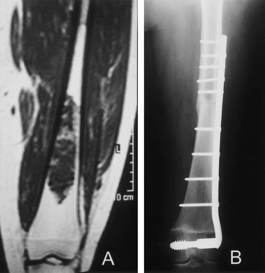98 Muscolo et al Clinical Orthopaedics and Related Research Fig 1A C.