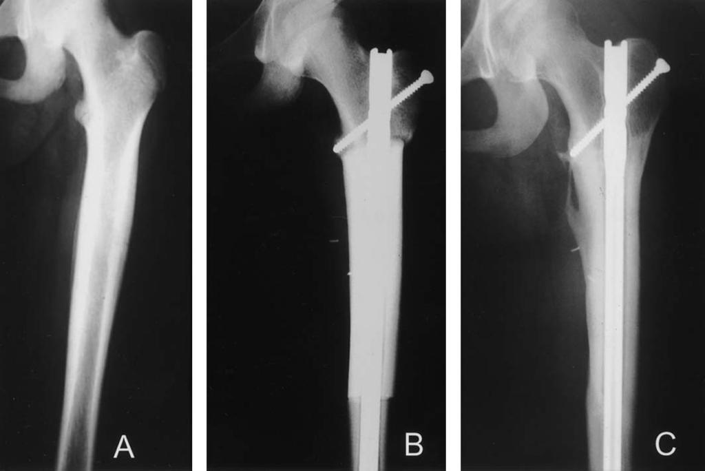 (A) The anteroposterior radiograph shows an Ewing s sarcoma of the femur.