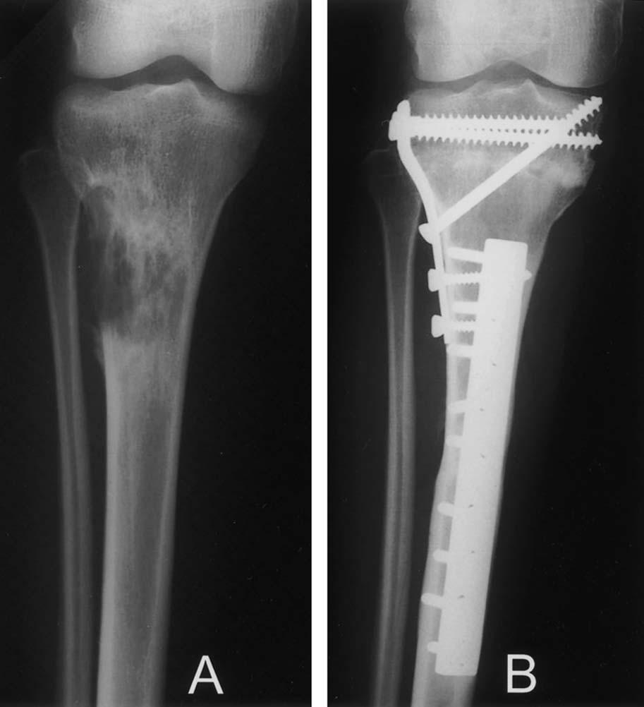 Number 426 September 2004 Intercalary Femur and Tibia Allografts 99 Fig 3A C.