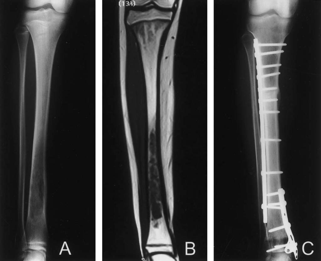100 Muscolo et al Clinical Orthopaedics and Related Research Fig 5A C.