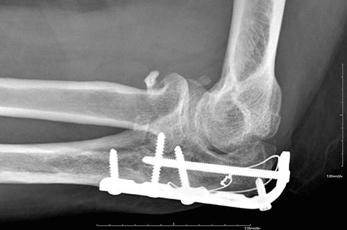 Discussion Articular maltracking occurred after a terrible triad and an anterior olecranon fracture dislocation pattern of injury.