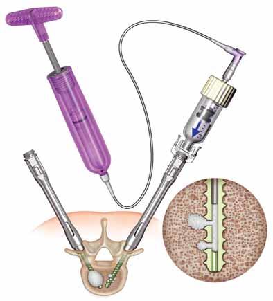 Place the cannula with cement reservoir through the alignment guide and into the screw shank. The cannula will click onto the alignment guide.