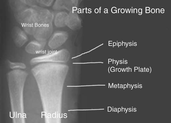 Pediatric Orthopedics 101 Long bones Diaphysis = Shaft Can bend through plastic deformation Fracture through one end = Greenstick Complete fracture Metaphysis = Flared end,