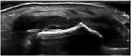 Musculoskeletal Ultrasound in Rheumatological Practice Detection of