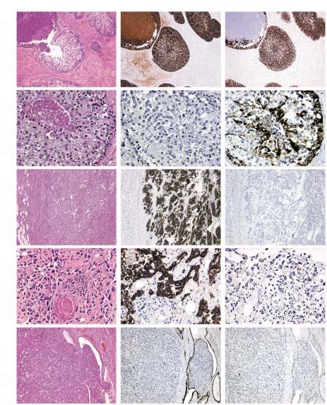 Bassily et al / CYTOKERATINS 7 AND 20 IN PROSTATE AND BLADDER CARCINOMAS H&E CK-7 CK-20 Case 5 Case 4 Case 3 Case 2 Case 1 Image 2 Case 1, High-grade urothelial carcinoma with extension into