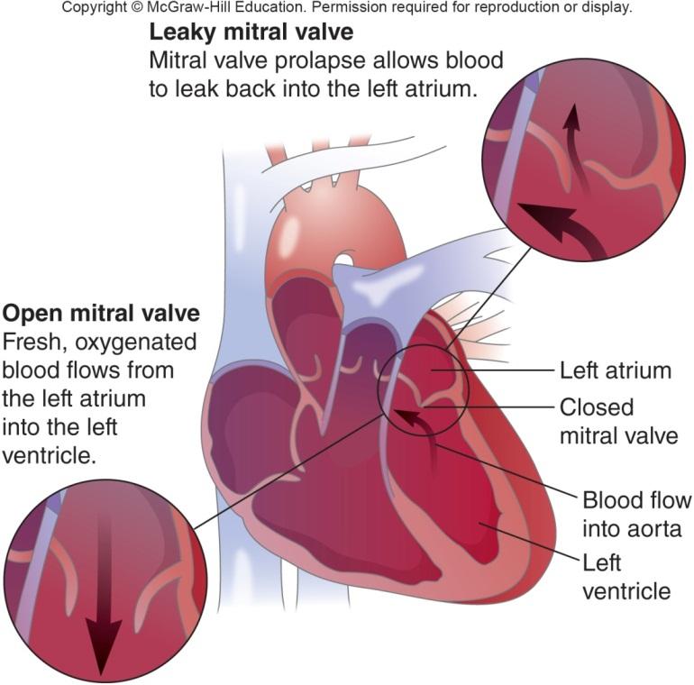 Other Cardiovascular Diseases Heart valve