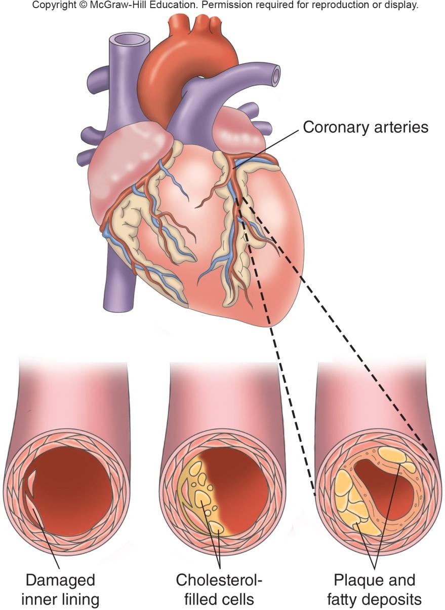 Atherosclerosis 1) Damage to the inner lining of vessels and the formation of a fatty streak 2) Accumulation of lipoproteins within the walls of an artery 3) Once an injury exists on the artery,