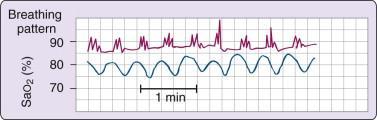 Breathing pattern and arterial oxygen saturation (Sao 2 ) in a normal subject during sleep at high altitude (4300 meters).