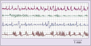 Impedance plethysmograms show irregular, nonperiodic, breathing during sleep