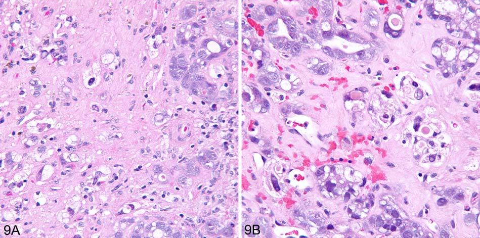 (B) Endometrioid yolk sac carcinoma is composed of glands lined by cuboidal cells in a back to back arrangement. H&E, x200. Fig. (9).