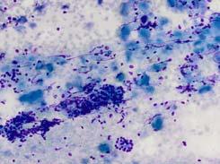 lymphocytic infiltration Plasma cells Cytologic Features of