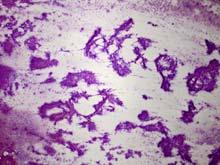 Intrapancreatic Accessory Spleen Cytologic Features Scattered tissue