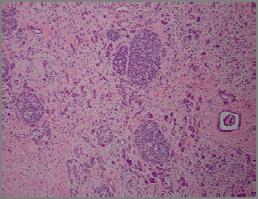 Neuroendocrine Tumor (PanNET) Cytologic