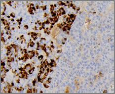 Mixed acinar cell carcinoma and