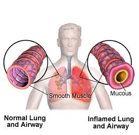The tissue lining the bronchioles thickens from scarring and causes a narrowing of the airways.