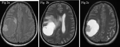 MRI Findings Of An Atypical Cystic Meningioma A Rare Case. The Internet Journal of Radiology. 2012 Volume 14 Number 1.
