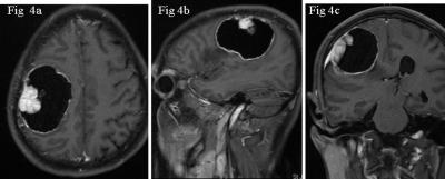 Figure 4 Fig 4a,b,c. Post-contrast axial, sagittal and coronal images reveal intense enhancement of the mural nodule and the cyst wall.
