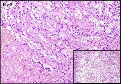Inset shows microcystic areas. Histopathology of the tissue disclosed an angiomatous meningioma with foci of microcystic components.