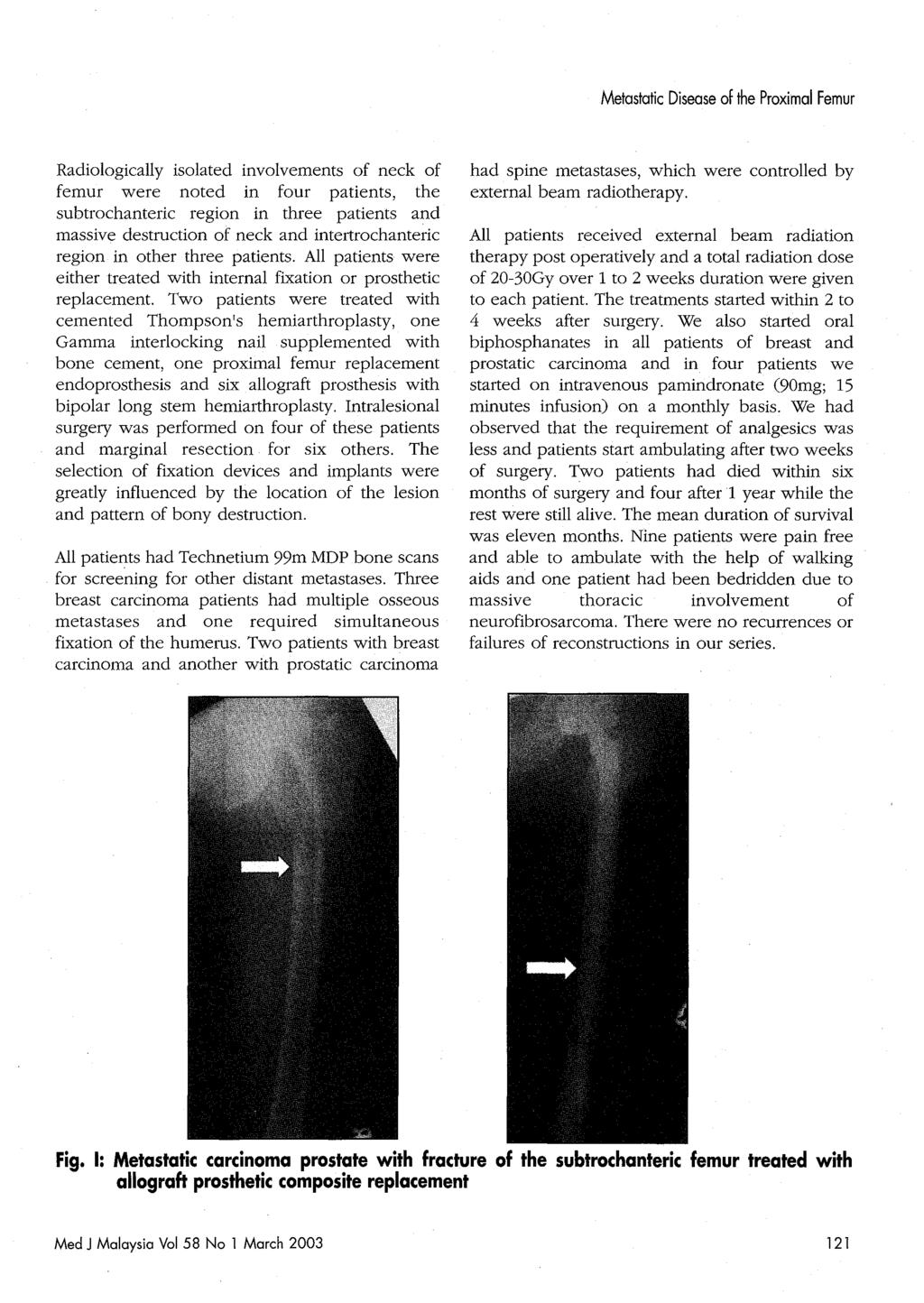 Metastatic Disease of the Proximal Femur Radiologically isolated involvements of neck of femur were noted in four patients, the subtrochanteric region in three patients and massive destruction of