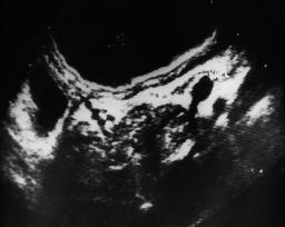 423 IJRI, 15:4, November 2005 Efficacy of High Resolution Transabdominal Sonography 423 the cases (100%). Patients with gastric carcinoma had a wall thickness ranging from 10mm to 32.