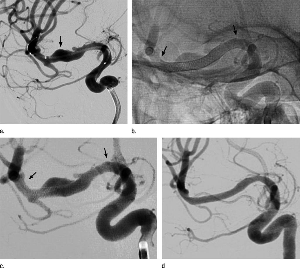 Figure 2 Figure 2: Fusiform aneurysm of M1 segment of right middle cerebral artery that was incidentally discovered at CT angiography in a 32-year-old woman.
