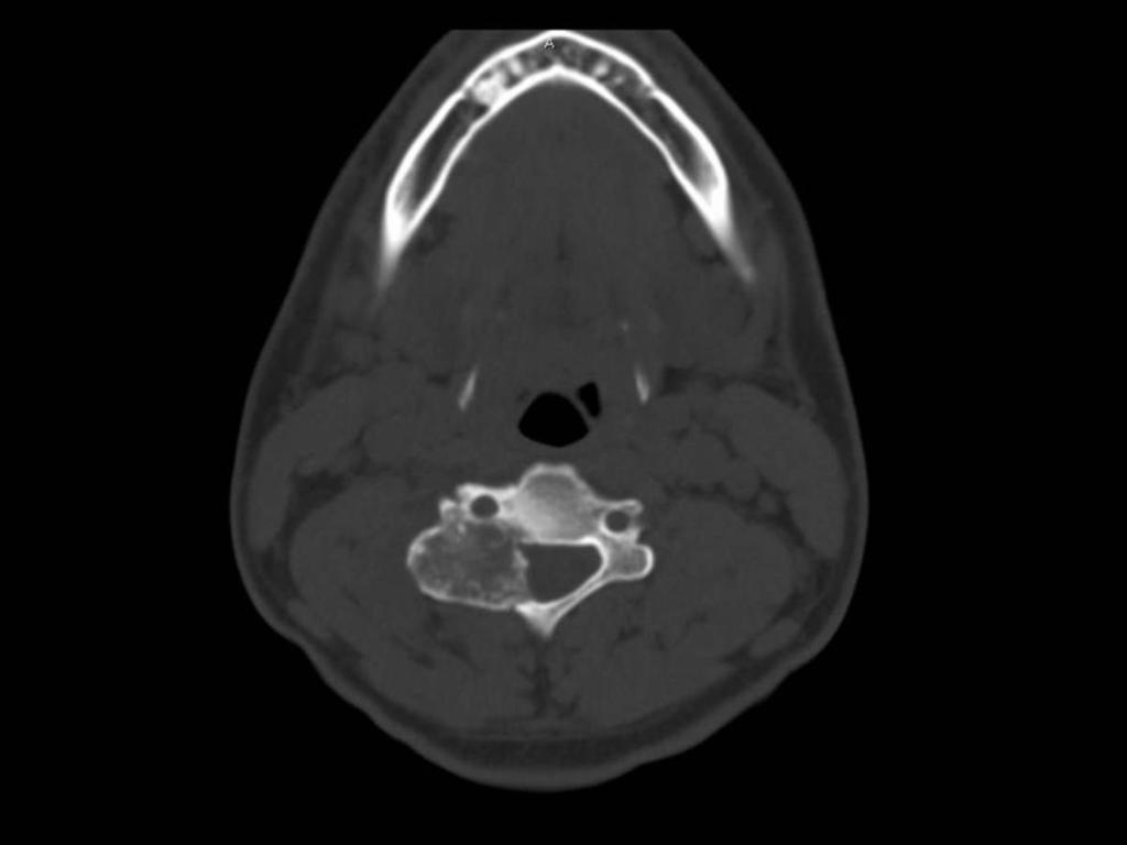Fig. 19: Osteoblastoma is seen on computed tomography in the posterior cervical spine