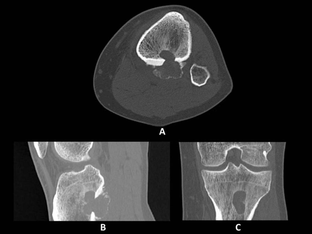 Fig. 21: Osteoblastoma. Same bone lesion seen in figure x.
