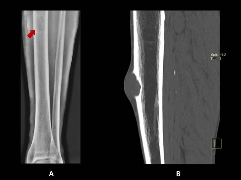 Fig. 31: Chondromyxoid fibroma. Anterior-posterior radiography (A) show a geographic lytic lesion in the diaphysis of left tibia.